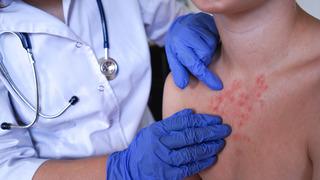 Vakalar dünyada artıyor: İngiltere MPOX virüsü alarmı verdi! Bu yeni bir varyant