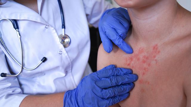 Vakalar dünyada artıyor: İngiltere MPOX virüsü alarmı verdi! Bu yeni bir varyant