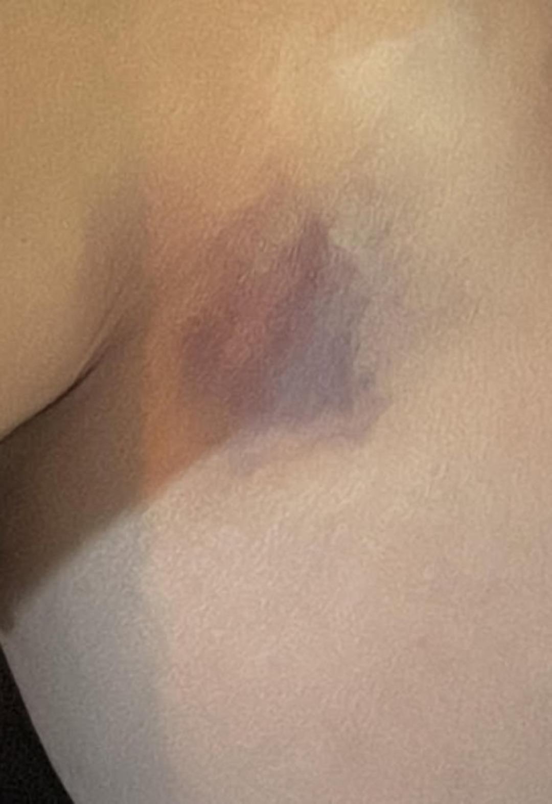 3. kez evlenmişti! Yıldız Asyalı eşinden şiddet gördüğünü açıkladı! Yüzünün ve boynunun son halini gösterdi 3