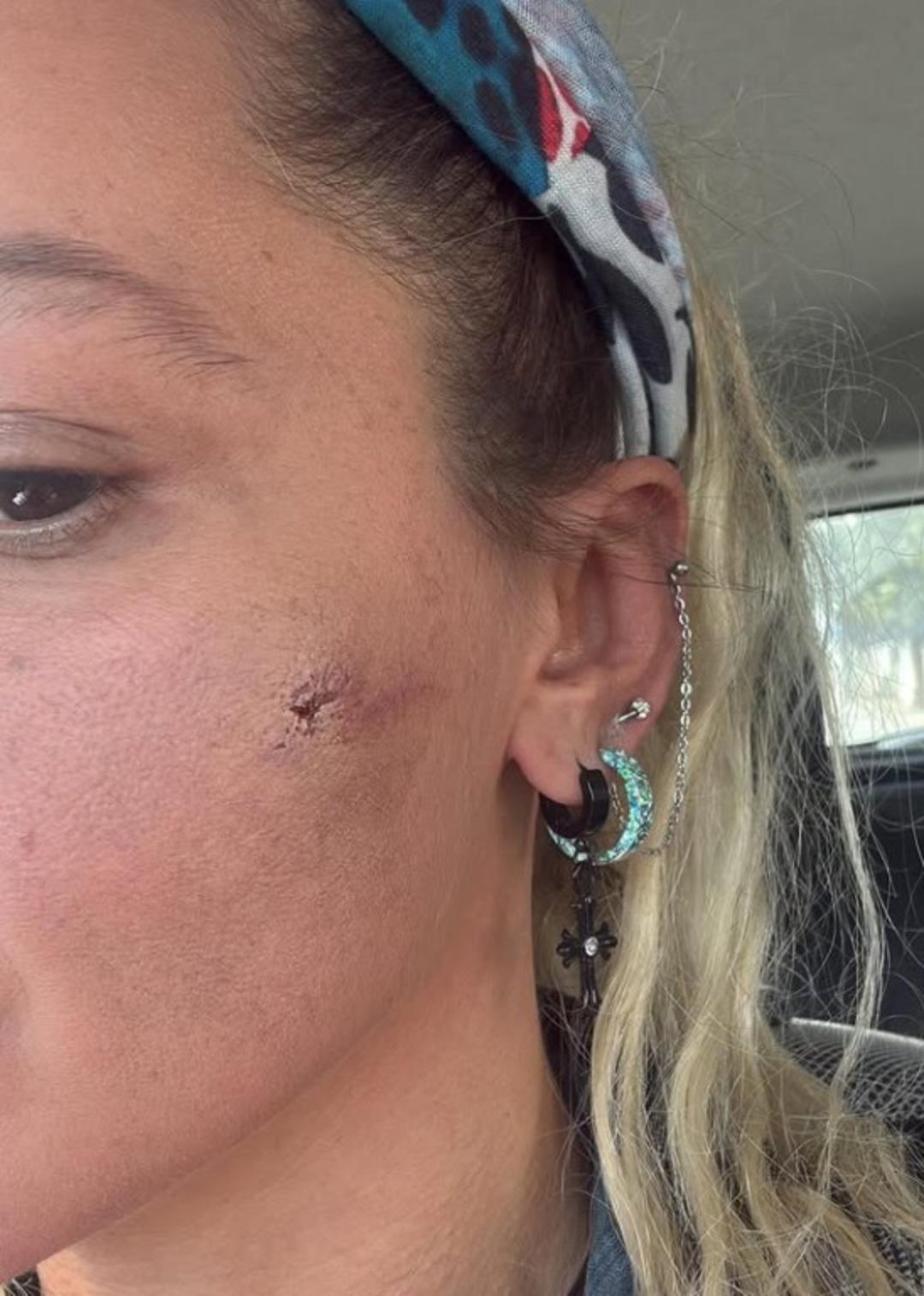 3. kez evlenmişti! Yıldız Asyalı eşinden şiddet gördüğünü açıkladı! Yüzünün ve boynunun son halini gösterdi 2