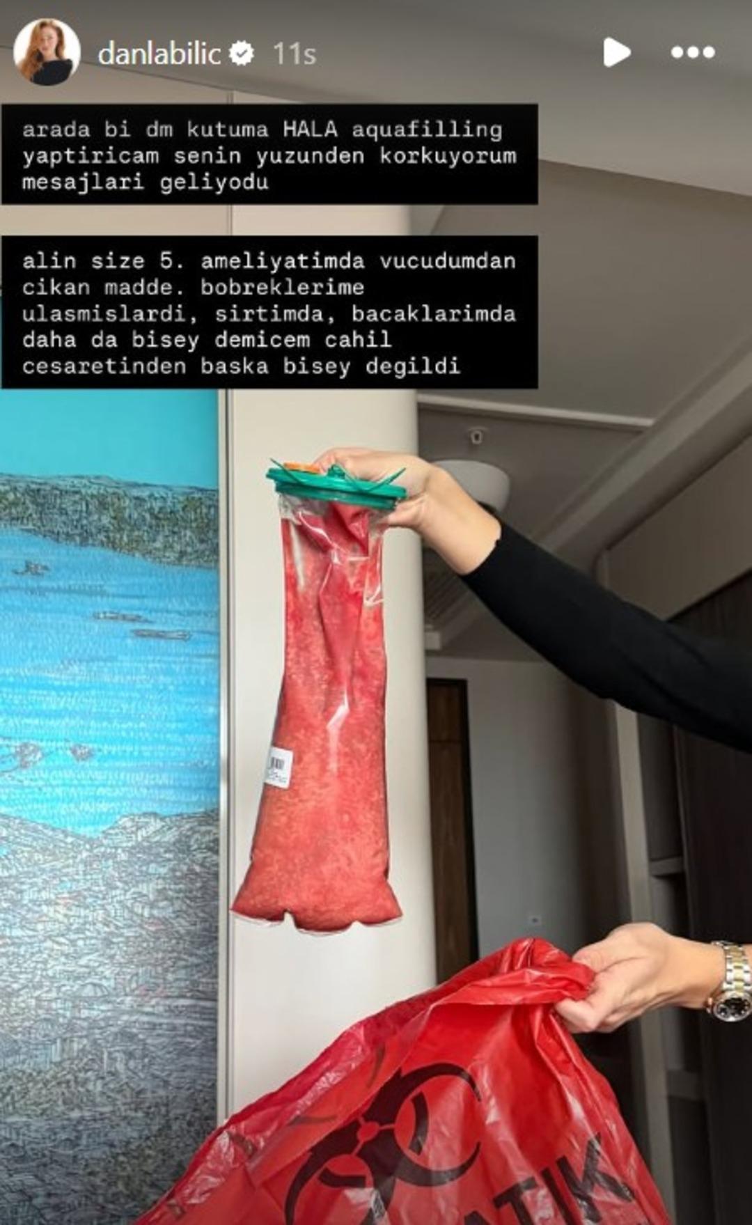 5. kez ameliyat masasına yattı! Danla Bilic vücudundan çıkan dolgu maddesini yayınladı! Görenler inanamadı 3