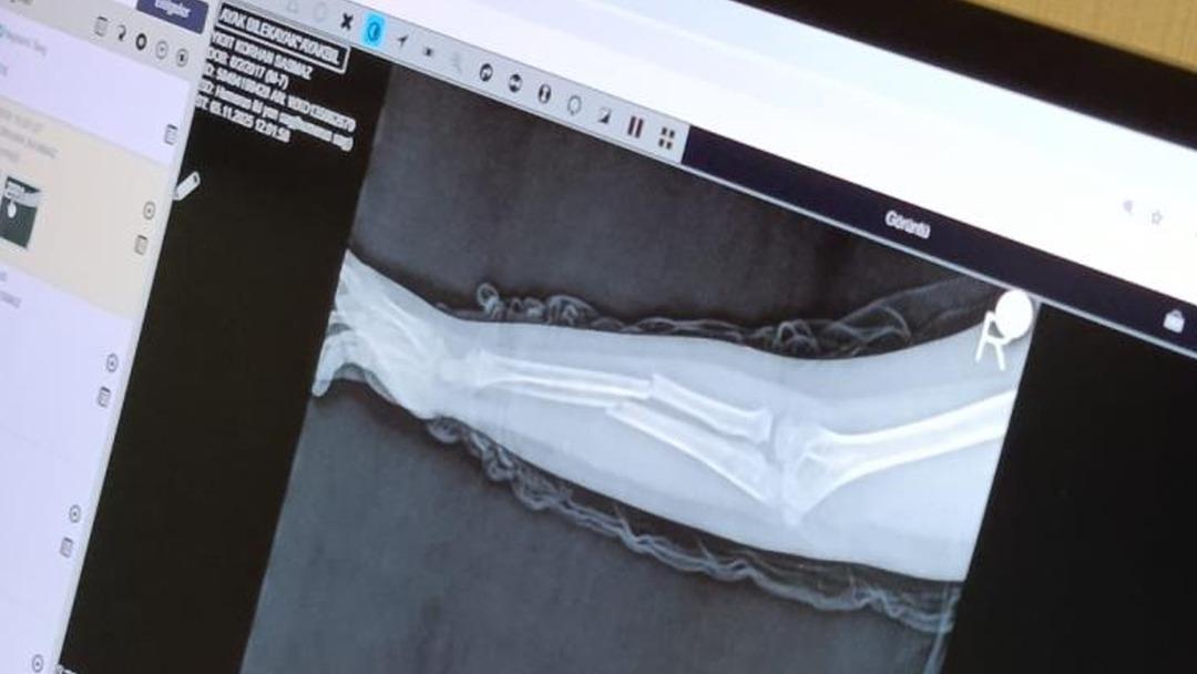 Biri 9 diğeri 8 yaşında! Kolunu 2 yerden kırdı: "Öğretmene şikayet ettiği için intikam almış" 3