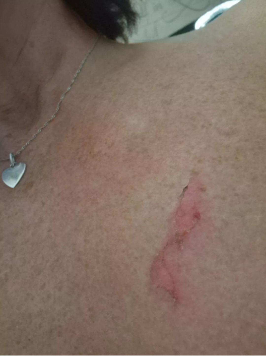 Satışları durdurdular! İnternetten aldığı sütyen göğsünü yaktı 1