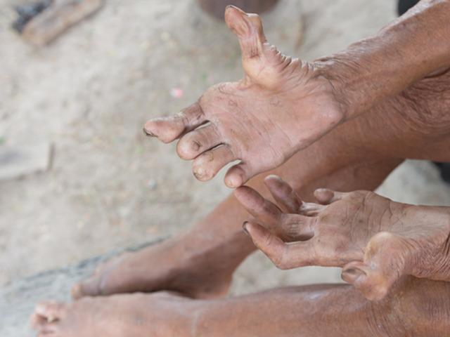 O hastalık 30 yıl sonra geri d&ouml;nd&uuml;