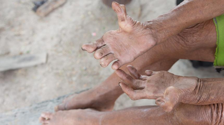 30 yıl sonra geri d&ouml;nen hastalık: Romanya ve Hırvatistan&rsquo;da c&uuml;zzam paniği!