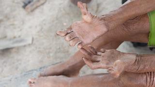 30 yıl sonra geri dönen hastalık: Romanya ve Hırvatistan’da cüzzam paniği!