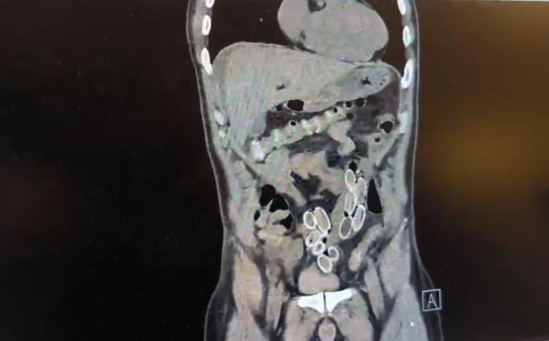 Mide ağrısıyla hastaneye gitti, tomografiyi g&ouml;ren doktorlar polise haber verdi! 2