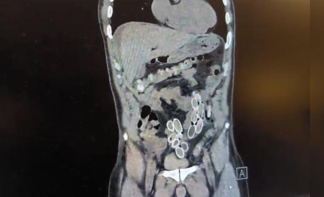 Mide ağrısıyla hastaneye gitti, tomografiyi g&ouml;ren doktorlar polise haber verdi! 1