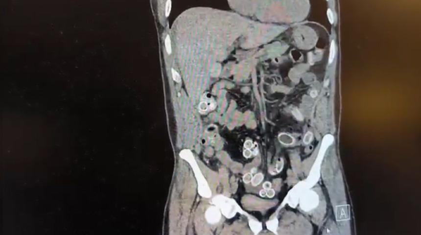 Mide ağrısıyla hastaneye gitti, tomografiyi g&ouml;ren doktorlar polise haber verdi!