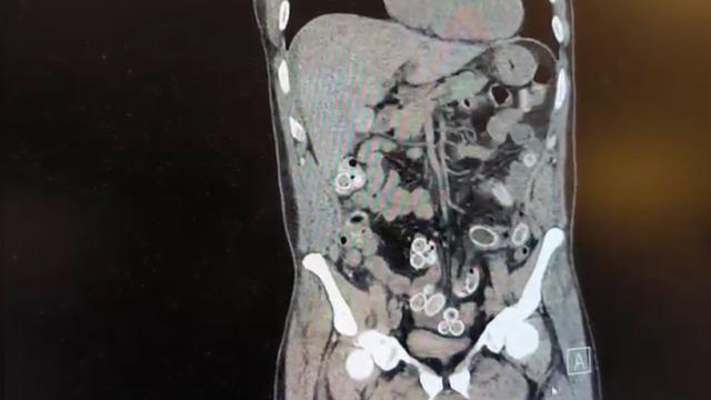 Mide ağrısıyla hastaneye gitti, tomografiyi gören doktorlar polise haber verdi!