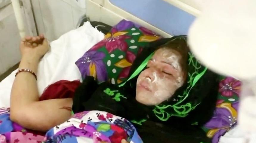 Erkek &ccedil;ocuk doğurmadı diye karısının y&uuml;z&uuml;ne asit attı!