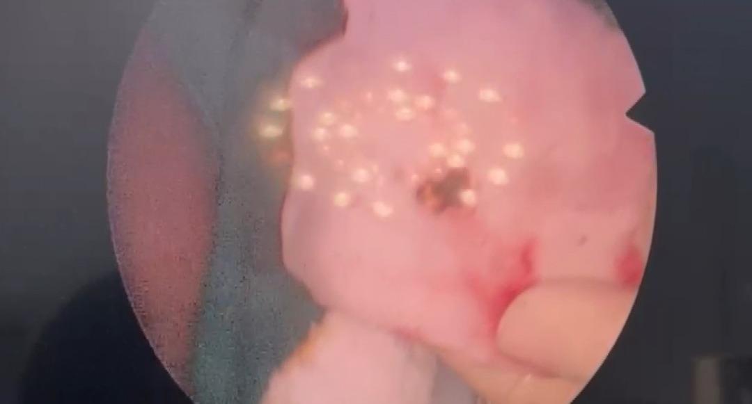 Doktorlar ilk kez b&ouml;yle g&ouml;rd&uuml;: Taş bu kez burundan &ccedil;ıktı! 1