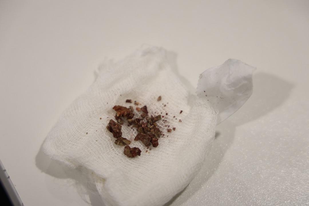 Doktorlar ilk kez b&ouml;yle g&ouml;rd&uuml;: Taş bu kez burundan &ccedil;ıktı! 4