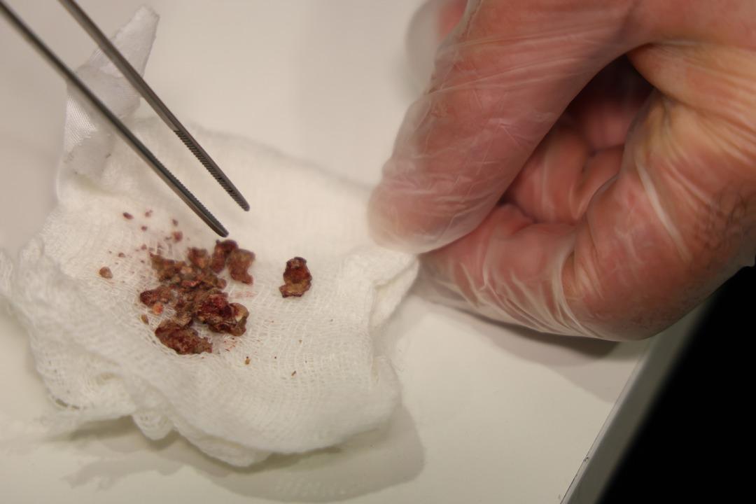 Doktorlar ilk kez b&ouml;yle g&ouml;rd&uuml;: Taş bu kez burundan &ccedil;ıktı! 3