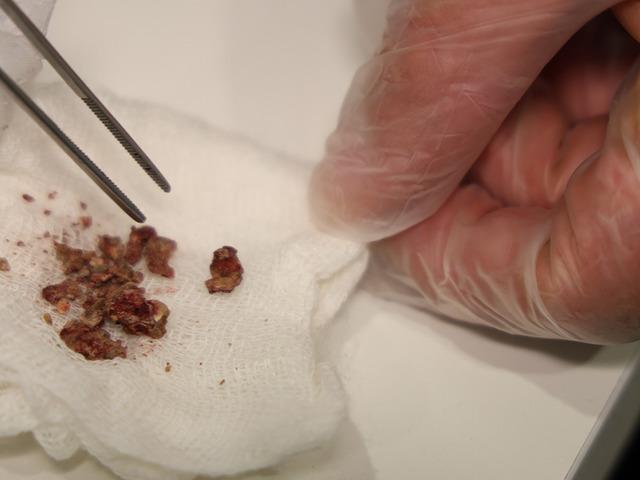 Doktorlar ilk kez b&ouml;yle g&ouml;rd&uuml;: Taş burundan &ccedil;ıktı!