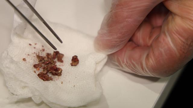 Doktorlar ilk kez böyle gördü: Taş bu kez burundan çıktı!