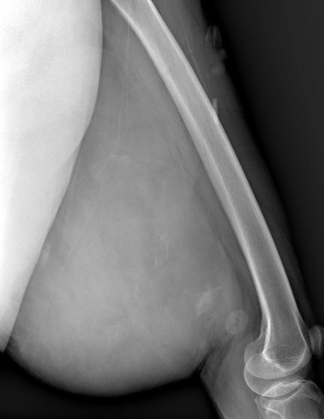 Böylesi hiç görülmedi! Bacaktan 5 kilo 668 gramlık dev kitle çıkarıldı 5