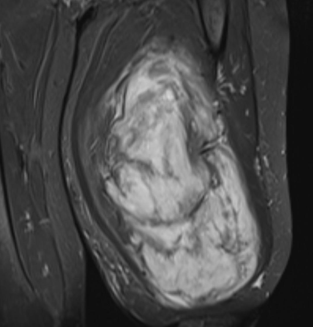Böylesi hiç görülmedi! Bacaktan 5 kilo 668 gramlık dev kitle çıkarıldı 1