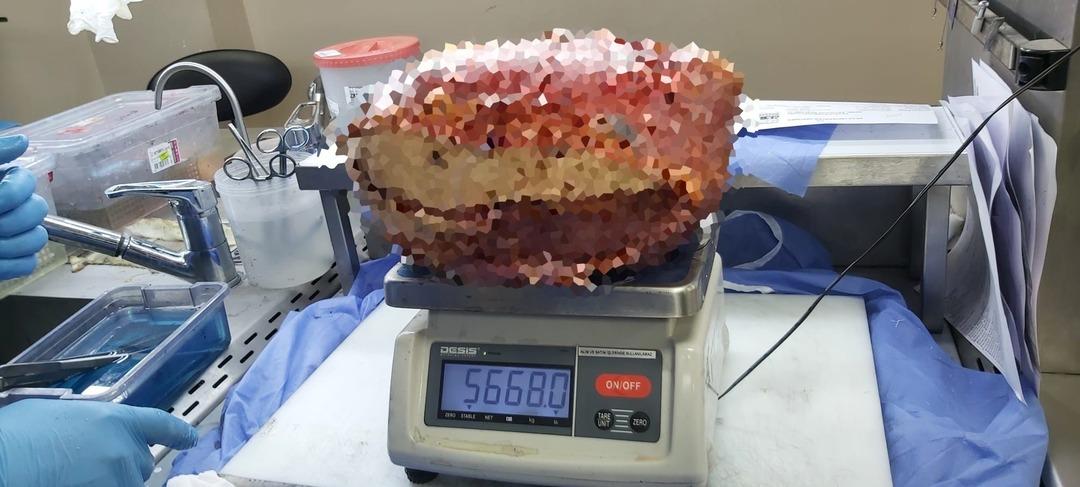 Böylesi hiç görülmedi! Bacaktan 5 kilo 668 gramlık dev kitle çıkarıldı 4