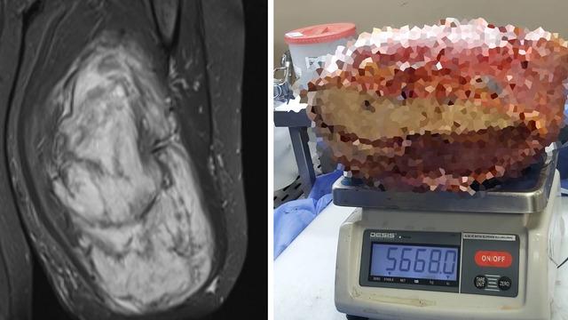 B&ouml;ylesi hi&ccedil; g&ouml;r&uuml;lmedi: 5 kilo 668 gramlık dev kitle &ccedil;ıkarıldı