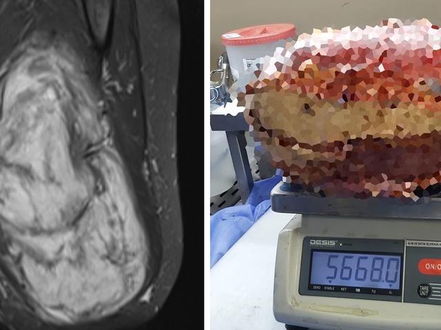 B&ouml;ylesi hi&ccedil; g&ouml;r&uuml;lmedi! Bacaktan 5 kilo 668 gramlık dev kitle &ccedil;ıkarıldı