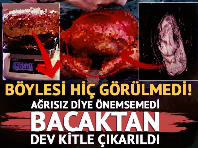 B&ouml;ylesi hi&ccedil; g&ouml;r&uuml;lmedi: 5 kilo 668 gramlık dev kitle &ccedil;ıkarıldı