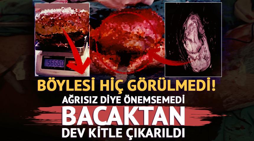 B&ouml;ylesi hi&ccedil; g&ouml;r&uuml;lmedi: 5 kilo 668 gramlık dev kitle &ccedil;ıkarıldı