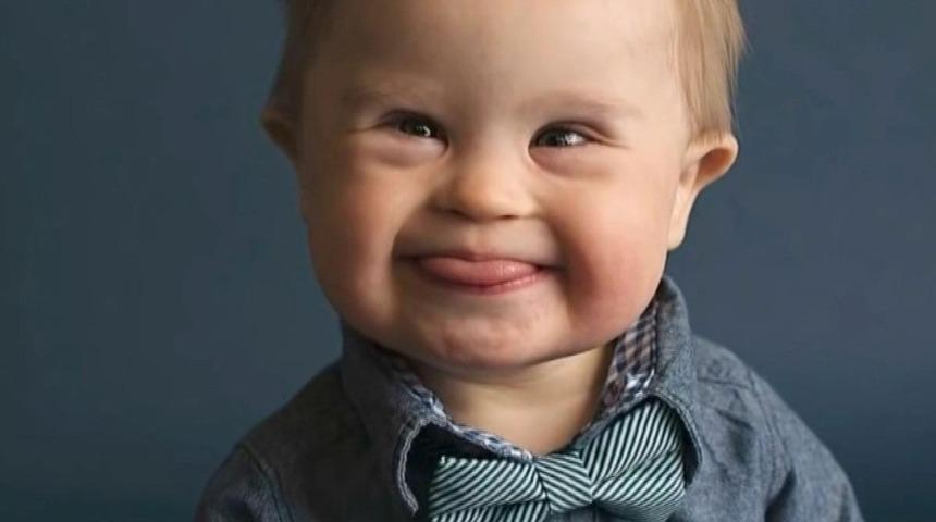 Down sendromu i&ccedil;in 1 yaşında m&uuml;dahale &ccedil;ok ge&ccedil;!