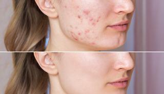 3 adımda silmenin y&ouml;ntemleri