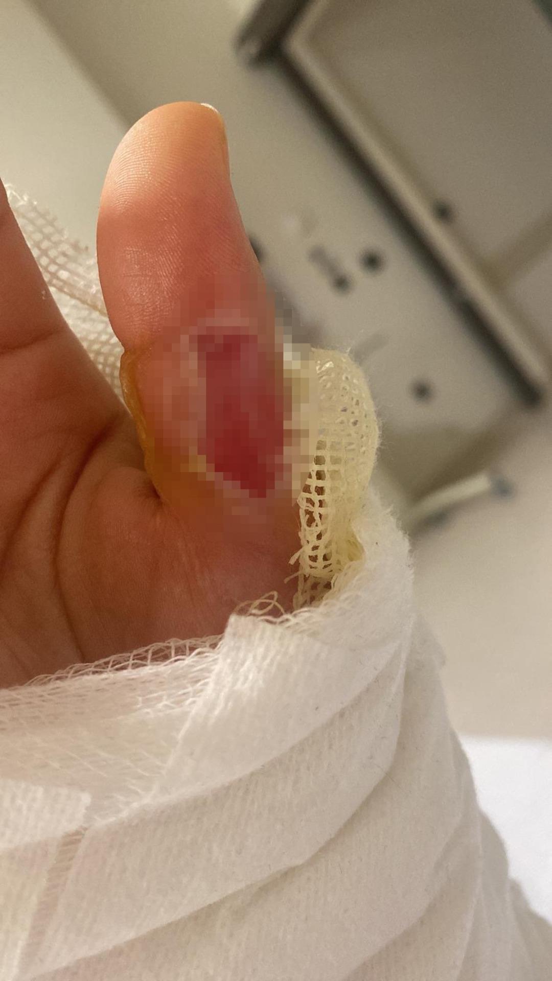 Gen&ccedil; kızın karnında sıcak su torbası patladı: "O acının tarifi yok" 3