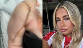 10 santim t&uuml;m&ouml;r &ccedil;ıkardılar: Kas ağrısı sandı kemik kanseri &ccedil;ıktı!