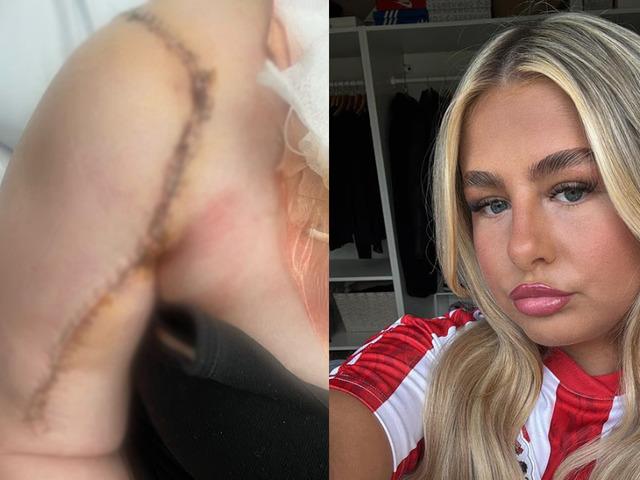 10 santim t&uuml;m&ouml;r &ccedil;ıkardılar: Kas ağrısı sandı kemik kanseri &ccedil;ıktı!