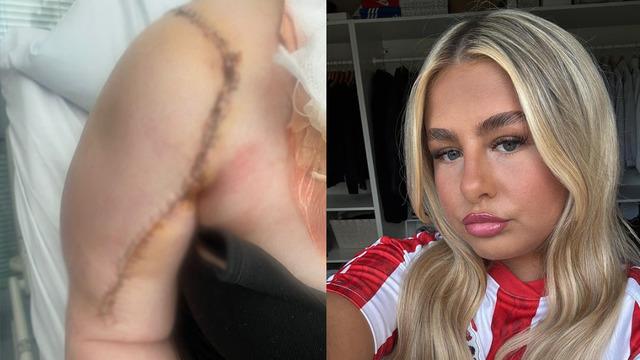 Kas ağrısı sanırken kemik kanseri çıktı! 16 yaşındaki kız omzundan 10 santimlik tümör taşıyormuş