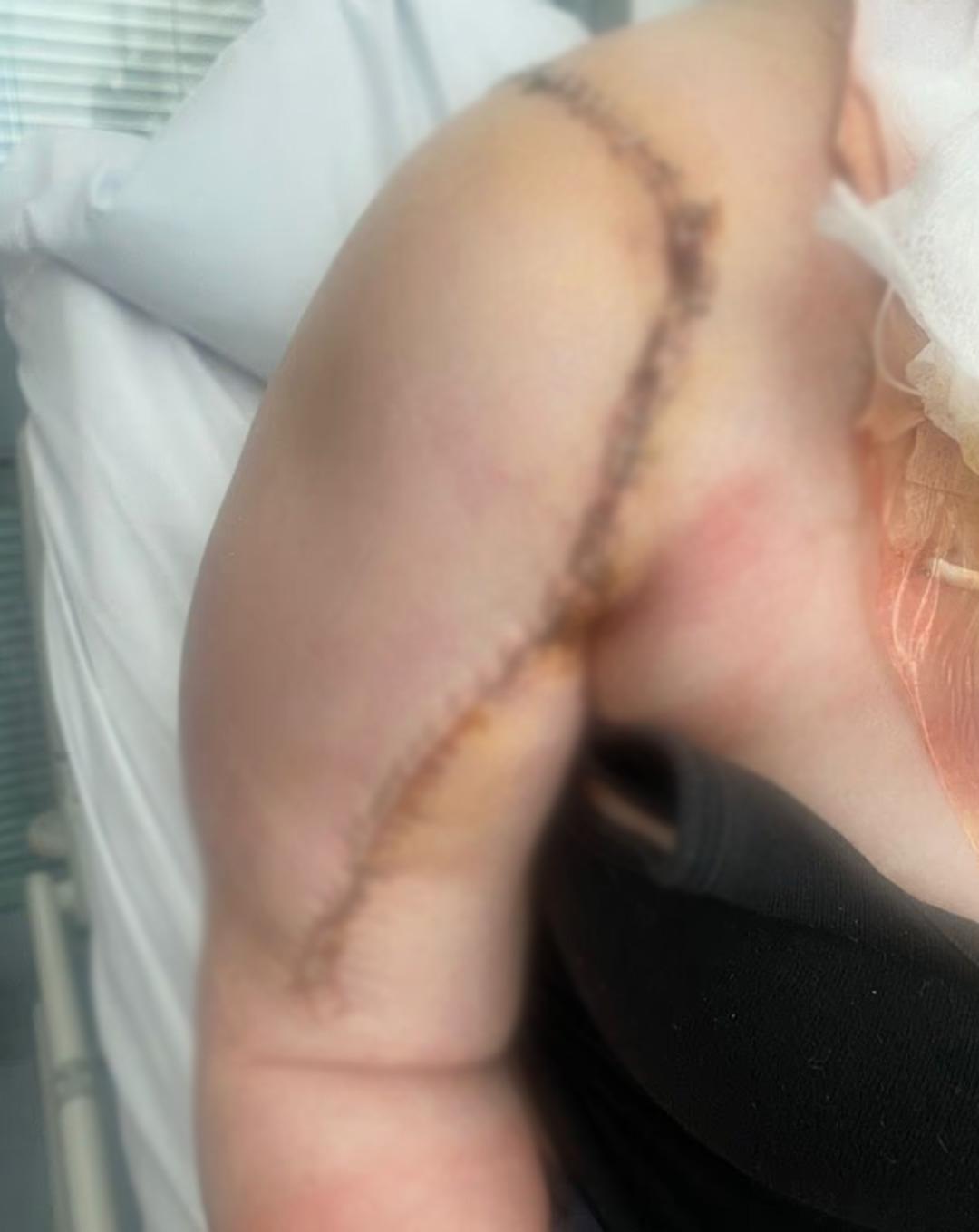 Kas ağrısı sanırken kemik kanseri &ccedil;ıktı! 16 yaşındaki kız omzundan 10 santimlik t&uuml;m&ouml;r taşıyormuş 2