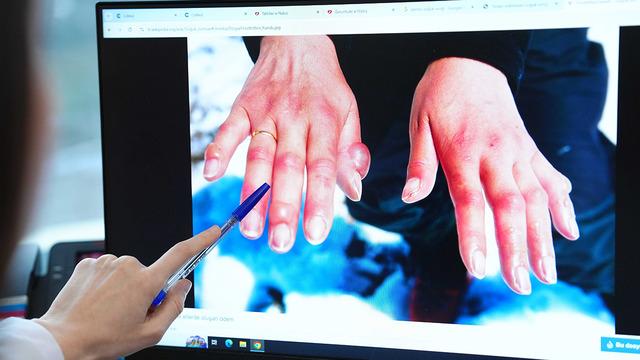 Kış aylarında vakalar artıyor! Soğuk havalarda uzuv kaybına karşı önleminizi alın