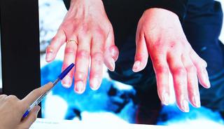 Kış aylarında 'soğuk ısırığına' dikkat! 