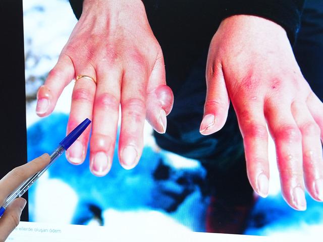 Kış aylarında 'soğuk ısırığına' dikkat! 