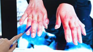 Kış aylarında 'soğuk ısırığına' dikkat! Soğuk ısırığı nedir?