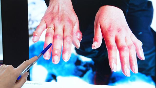 Kış aylarında 'soğuk ısırığına' dikkat! Soğuk ısırığı nedir?