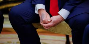 Trump'ın elindeki morlukların sebebi belli oldu