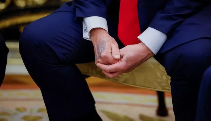 Trump'ın elindeki morlukların sebebi belli oldu