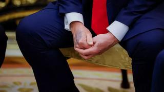 Donald Trump'ın elinin o görüntüsü tüm dünyada gündem olmuştu! Sebebini sonunda açıkladı