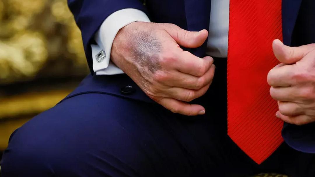 Donald Trump ın elinin o g&ouml;r&uuml;nt&uuml;s&uuml; t&uuml;m d&uuml;nyada g&uuml;ndem olmuştu! Sebebini sonunda a&ccedil;ıkladı 1