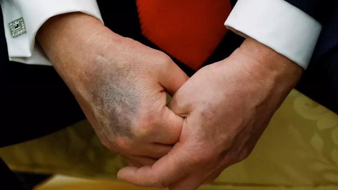 Donald Trump ın elinin o g&ouml;r&uuml;nt&uuml;s&uuml; t&uuml;m d&uuml;nyada g&uuml;ndem olmuştu! Sebebini sonunda a&ccedil;ıkladı 3