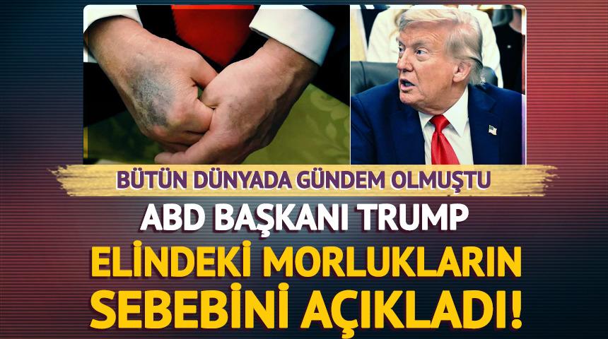 Trump'ın elindeki morlukların sebebi belli oldu