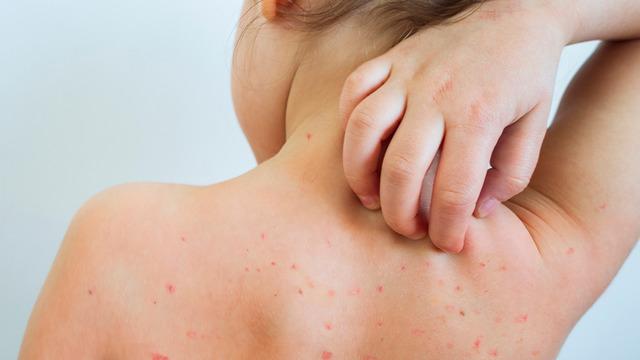 Okullarda suçiçeği alarmı! Veliler tedirgin: Bu belirtiler varsa dikkat