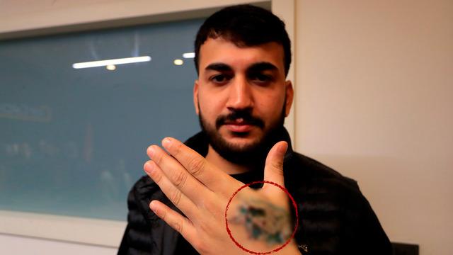 Dövme sildirmek için güzellik merkezine gitti, elini kaybediyordu! 