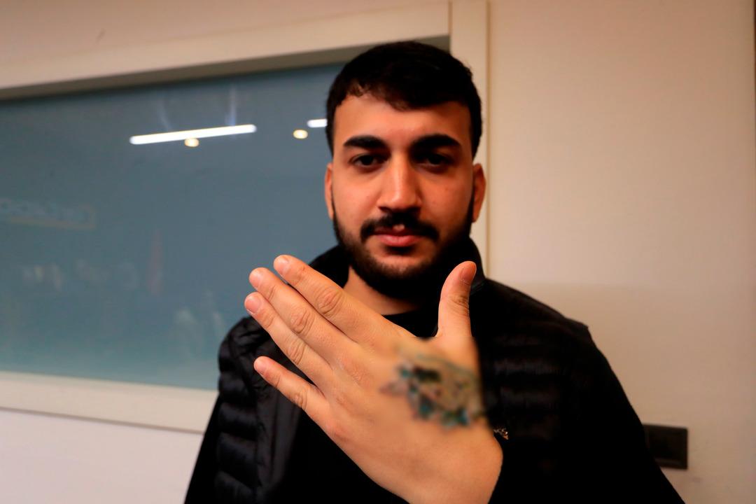 Dövme sildirmek için güzellik merkezine gitti, elini kaybediyordu! 3