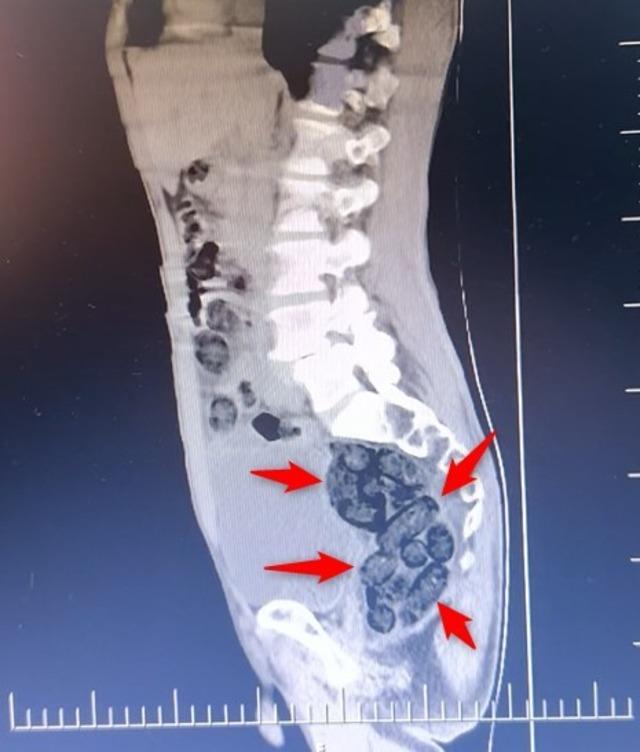 Batman’da yabancı uyruklu bir şahsın midesinden 64 parça uyuşturucu çıktı 5