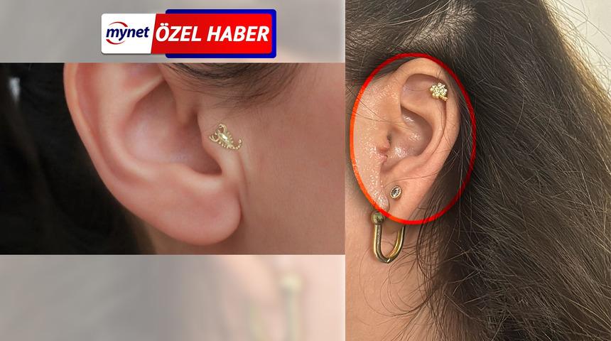 MYNET &Ouml;ZEL | Piercing kabusu: 8 yıl sonra kulağı ikiye ayrıldı! 